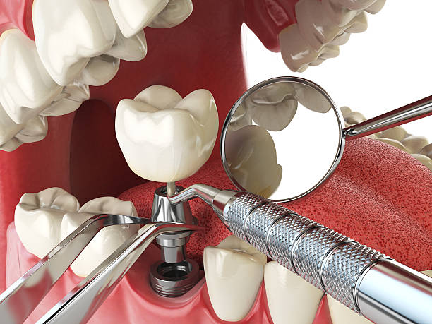 Best Emergency Tooth Extraction in Maineville, OH