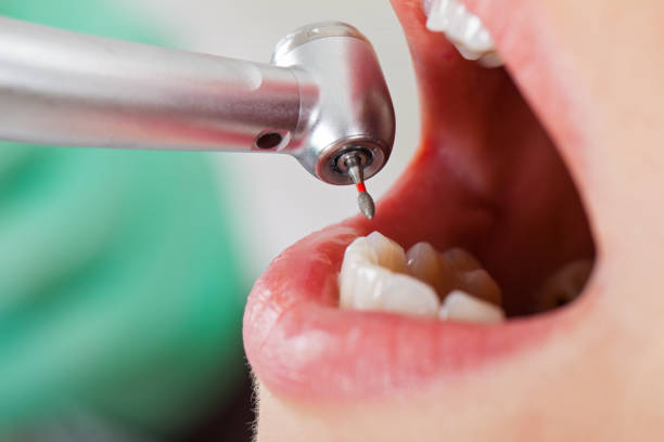 Best Emergency Wisdom Teeth Removal in Maineville, OH
